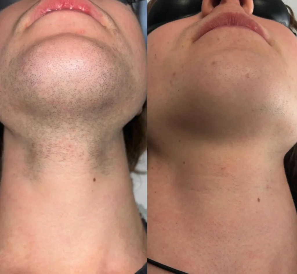 laser hair removal
