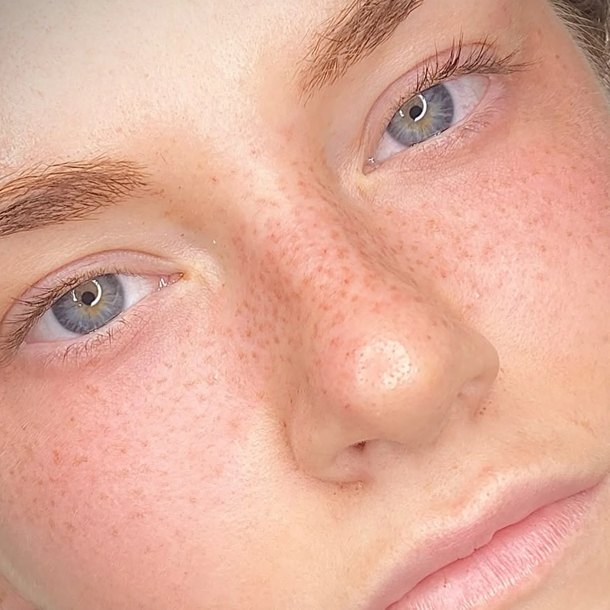 visible freckles on skin